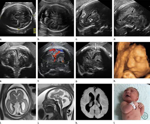 Na sequência, as imagens mostram como o cérebro do bebê vai sendo afetado pelo Zika vírus.