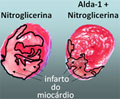 Miocardio Nitroglicerina